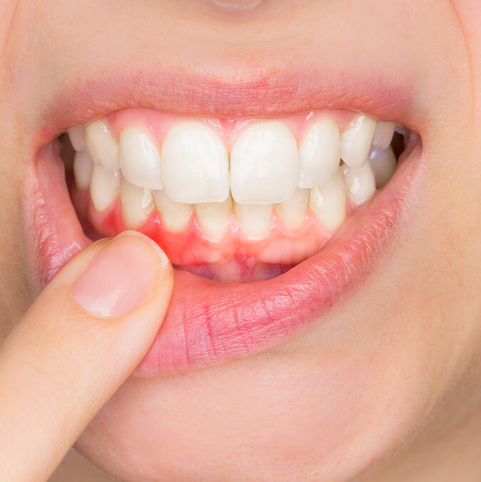 Si te sangran las encías acude a tu dentista.