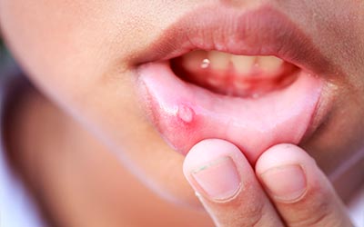 ¿Qué son las aftas?