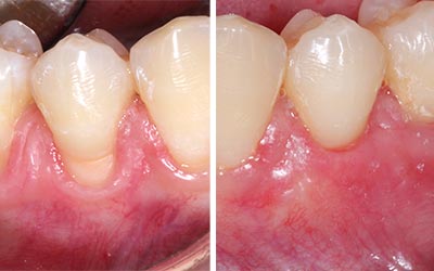Cirugía Periodontal